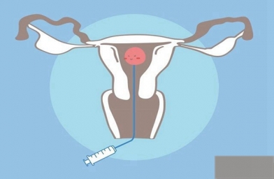 为什么在进行试管婴儿手术还是会出现宫外孕？